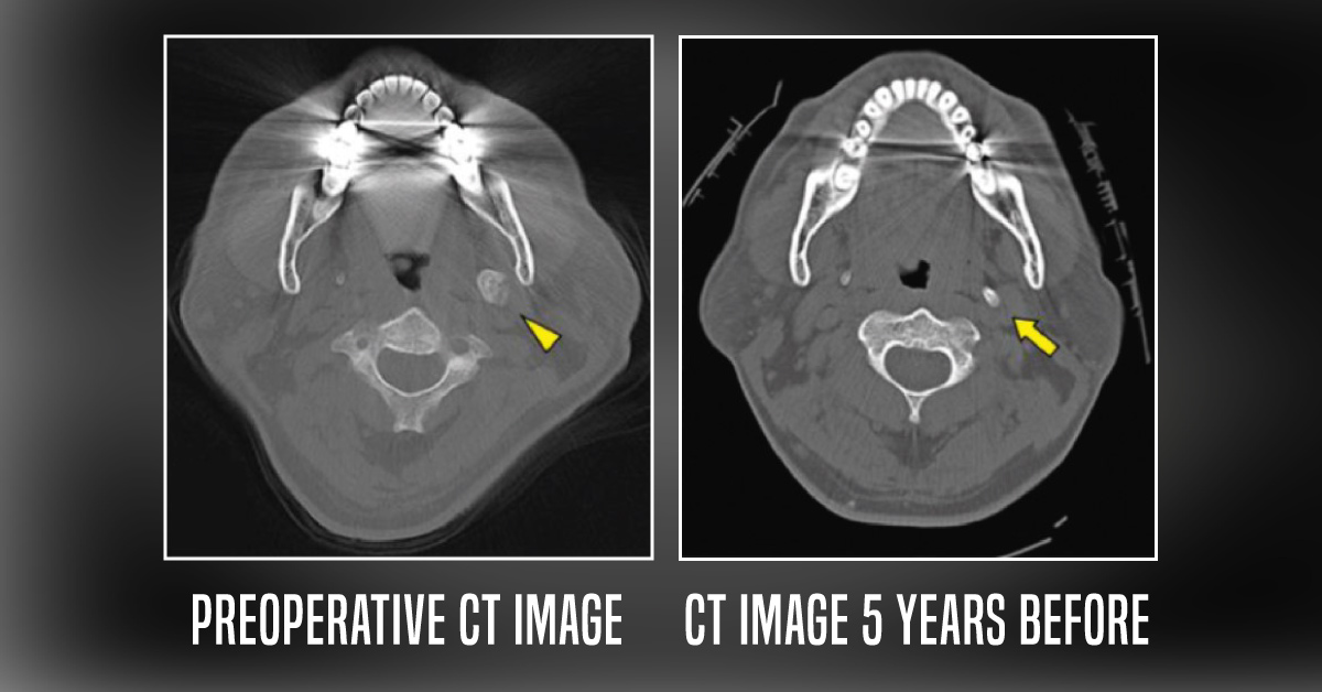 Case of a Man with a 3-year History of Throat Pain and Trismus