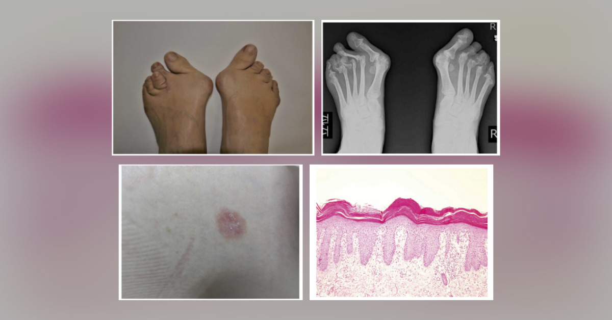A Woman with Plantar Pain, Gait Disturbance, and Toe Deformities – What's Your Diagnosis?