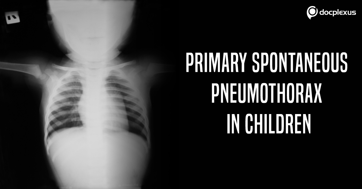 Treatment for the First Attack of Primary Spontaneous Pneumothorax in Children