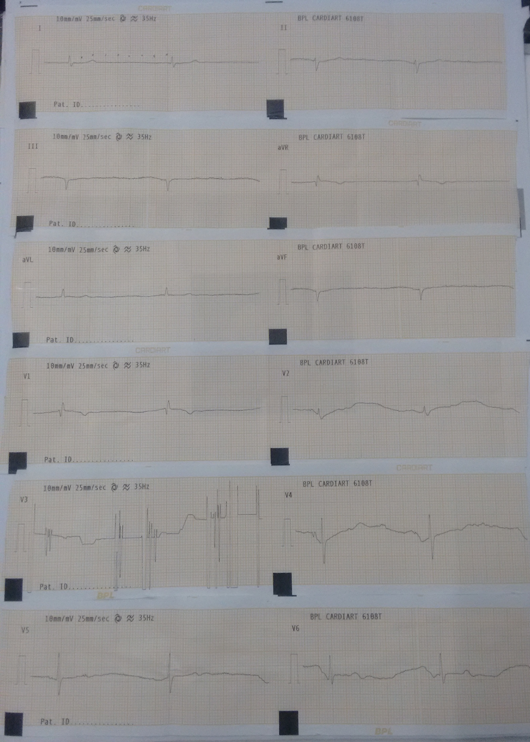 Interpret ECG Findings And Management