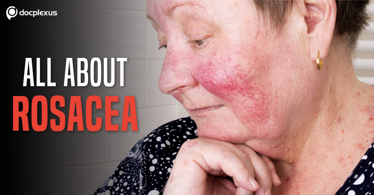 Rosacea: Diagnosis and Management