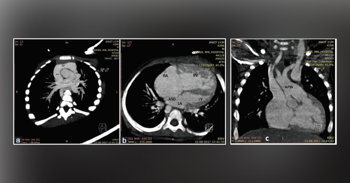 Aortopulmonary Window in an Infant