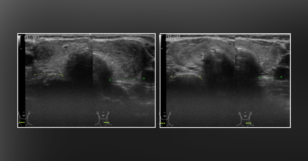 Identify The Cause of Thyrotoxicosis in This Patient