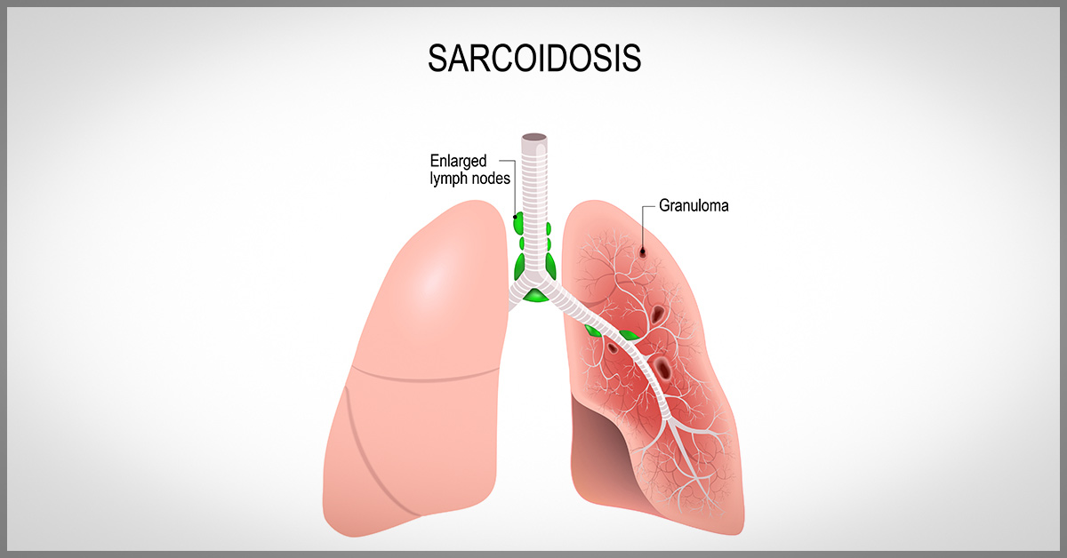 Brief Review On The Ocular Manifestations Of Sarcoidosis