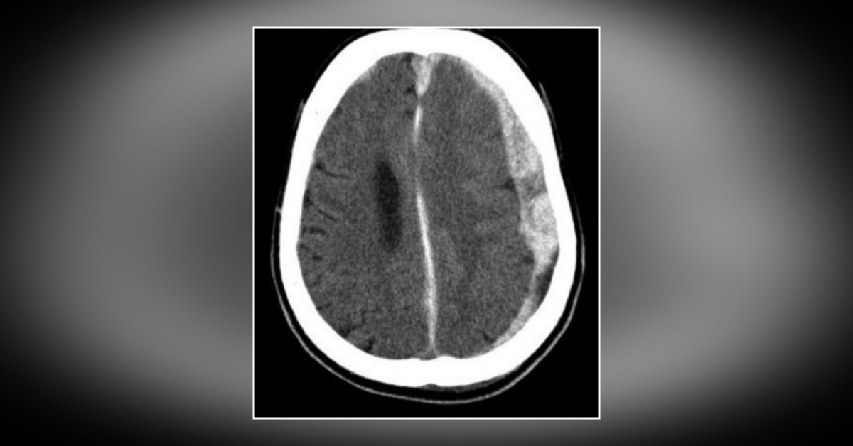 A Woman with a Traumatic Brain Injury