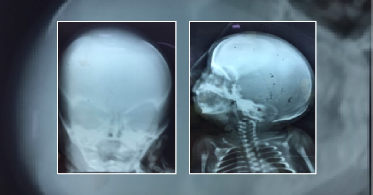A Case of Boneless Skull