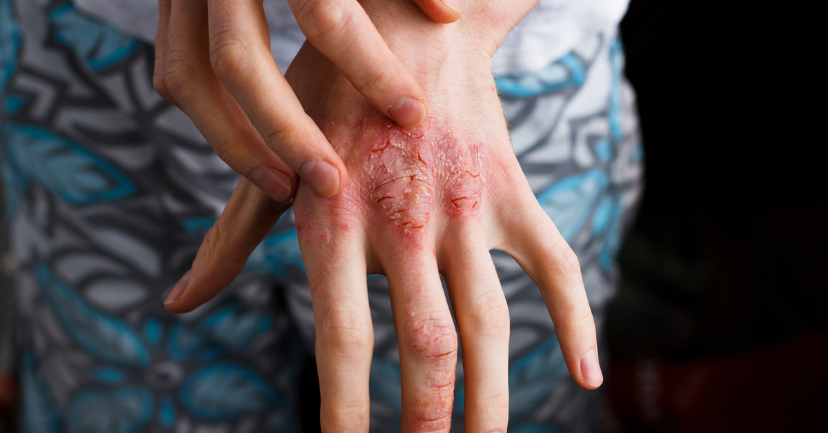 Monitor Patient With Atopic Dermatitis For Suicide As They Are Prone To It