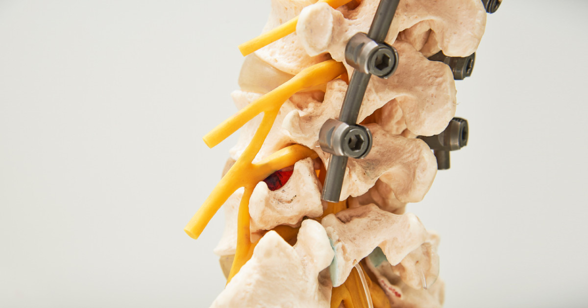 Unilateral Vs Bilateral Pedicle Screw: Treatment Option For Lumbar Degenerative Diseases