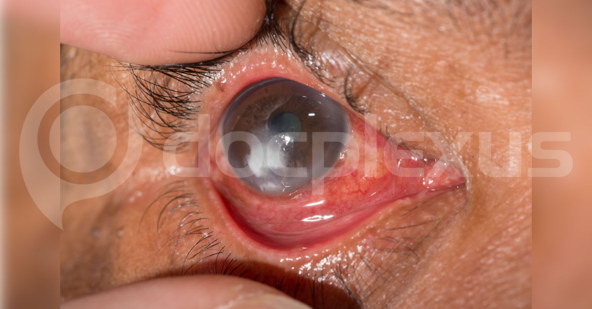 Brief Review On Pupilary Abnormalities