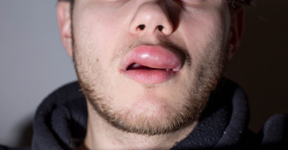 Hereditary Angioedema: A Rare Condition