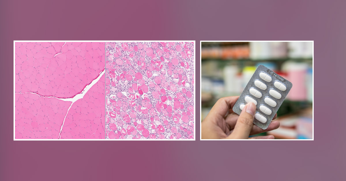 Uncommon Interaction Of Ciprofloxacin And Simvastatin Leading To Rhabdomyolysis