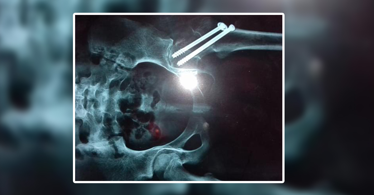 Complained About Hip Joint