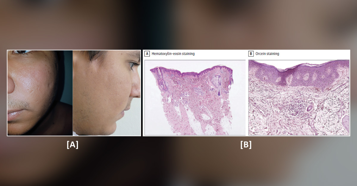 Identify These Scar-like Lesions on the Face