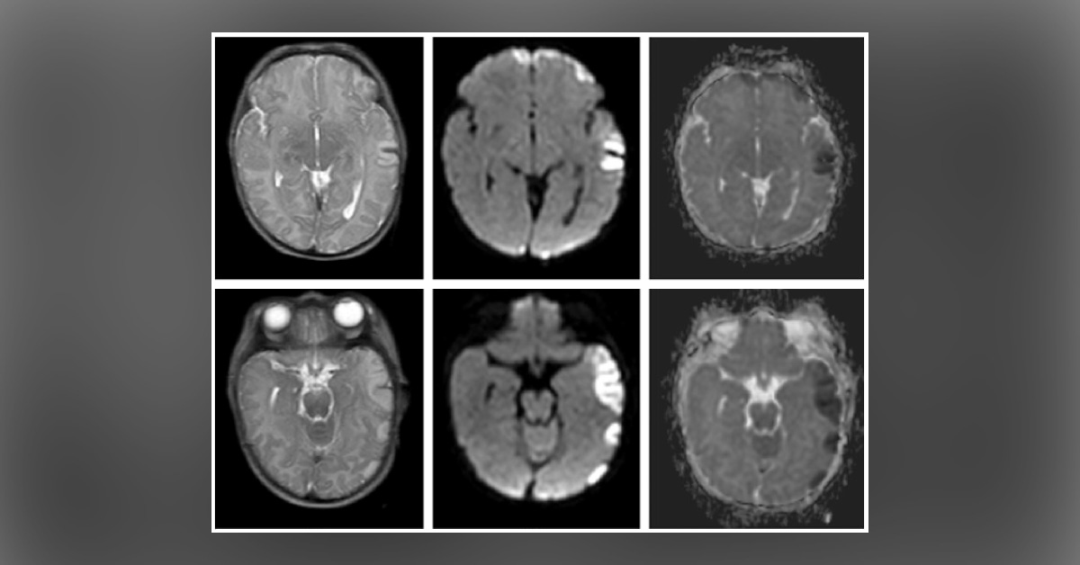 Does Diffusion-weighted Imaging Have a Diagnostic Value in Pediatric Neuroimaging?