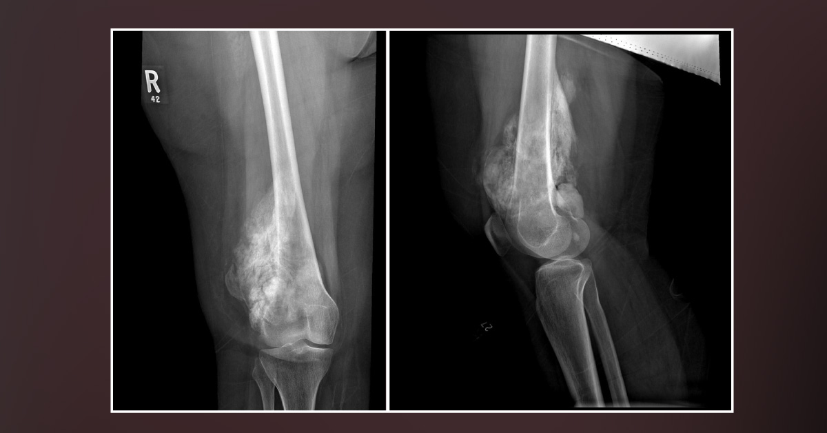 Mass in the Distal Thigh