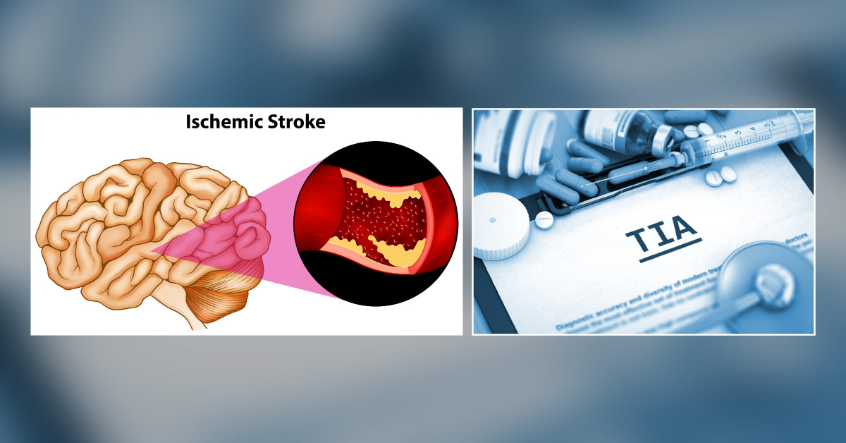 Expert Panel: Dual Antiplatelet Therapy Only Up To 3 Weeks In Minor Stroke
