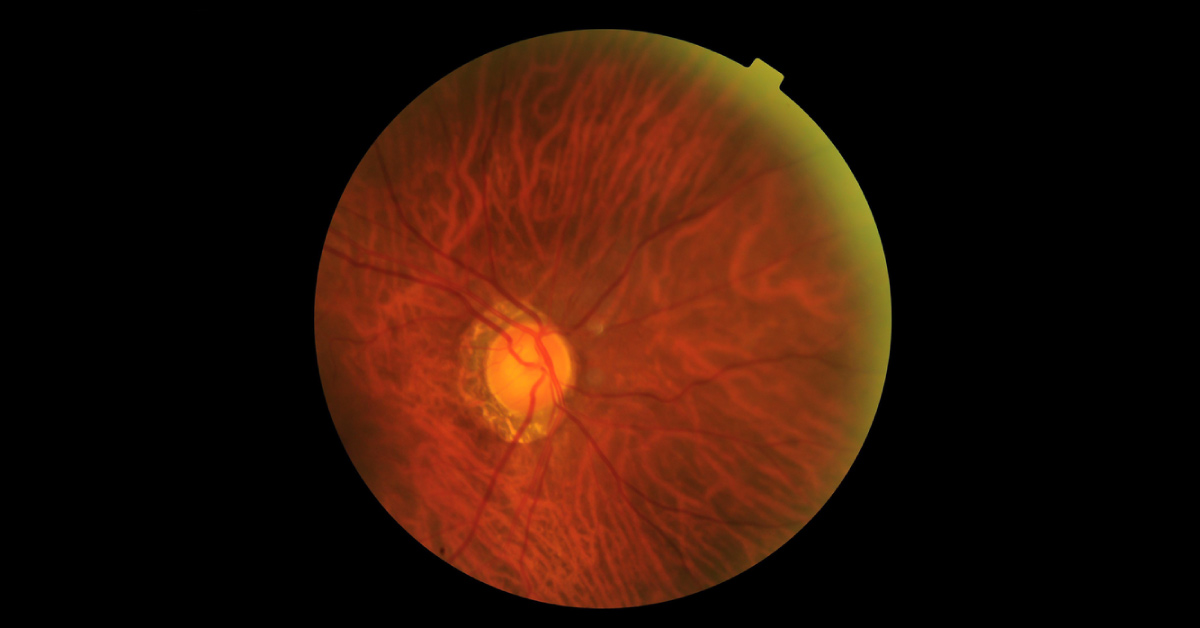 Congenital Conditions Associations With Optic Disc