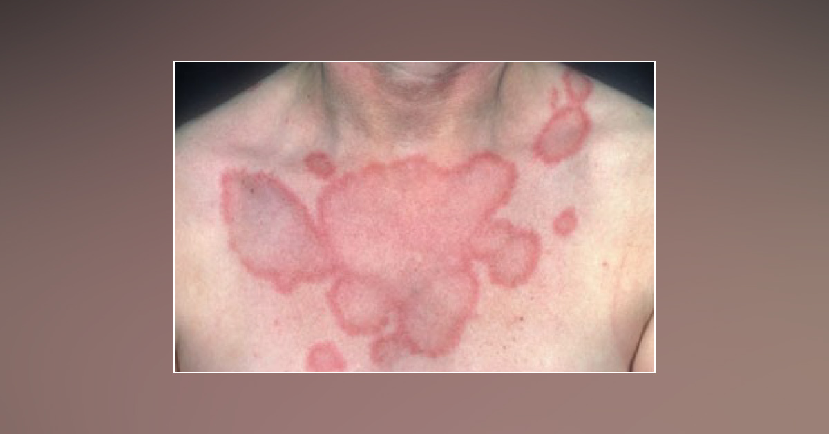 An Annular Erythematous Rash of Sudden Onset