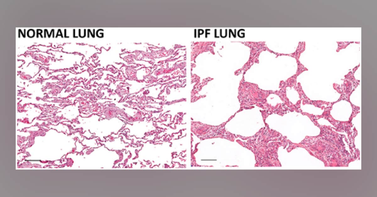 Dentists At Risk Of Lung Disease?