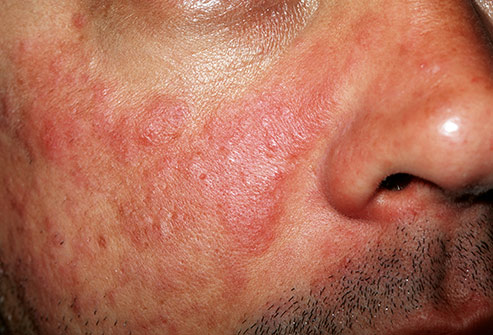 Diagnose The Lesions On The Cheeks And Nose