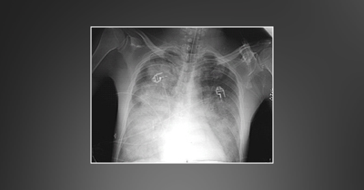 A Case of Acute Respiratory Failure