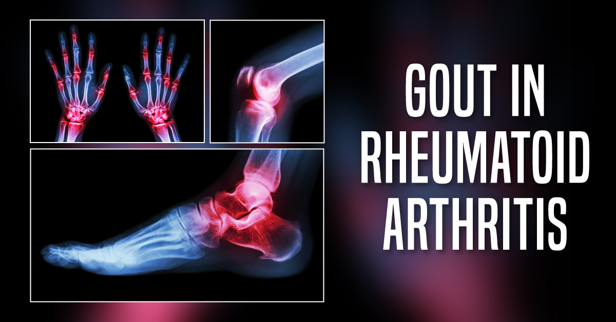 Coexistence Of Gout And Rheumatoid Arthritis