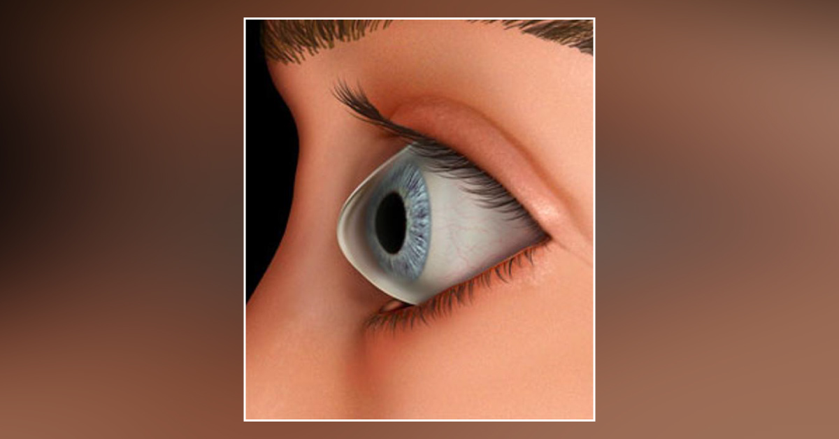 Brief Review On The Ocular And Systemic Associations Of Keratoconus