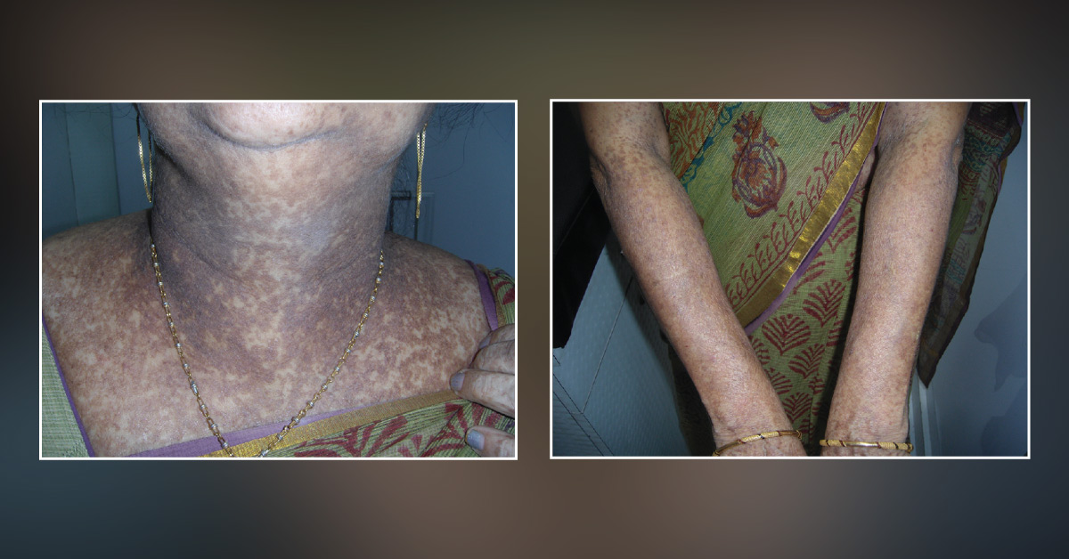 A Woman with Multiple Hyperpigmented Lesions on Her Body Since Puberty - What's Your Diagnosis?