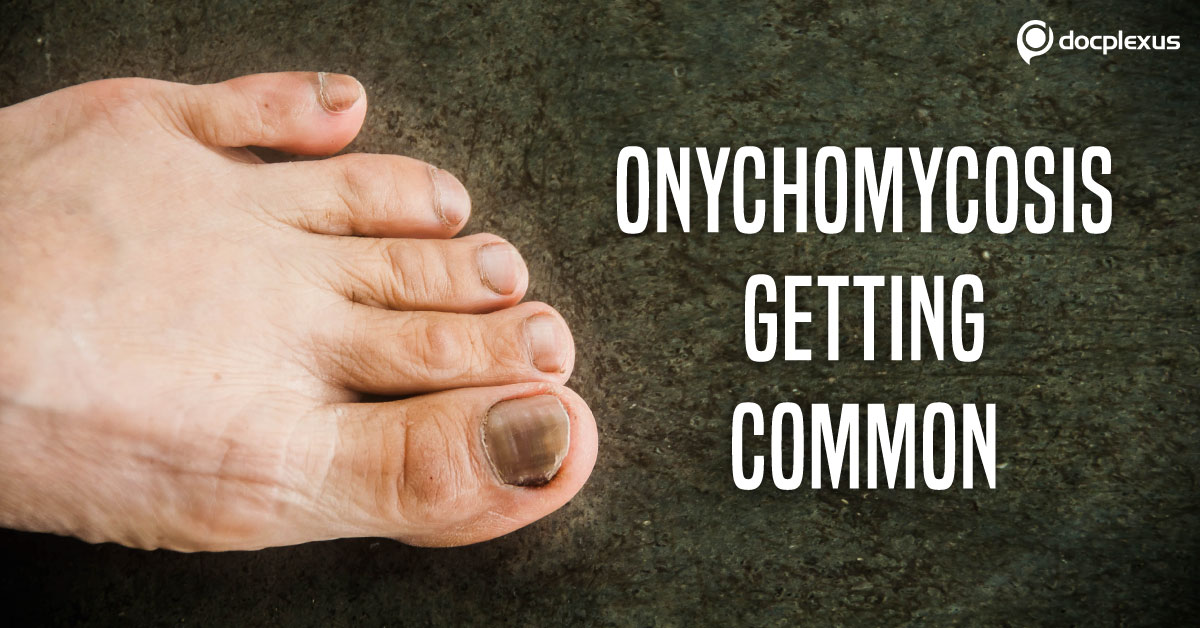 Fungal Nail Infections: Diagnosis and Management