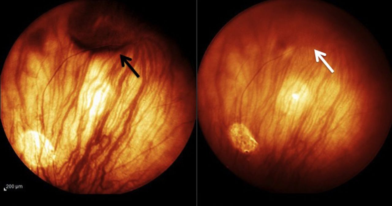 Are The Vertex Varies Presenting As Uveal Melanoma