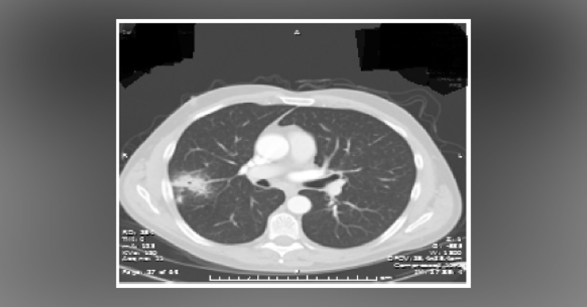 Case Of Recurrent Chest Infections