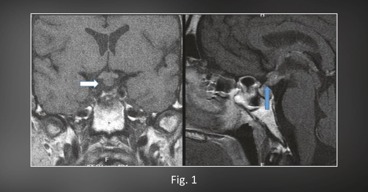 A Rare Case of Pituitary Stalk Inflammation