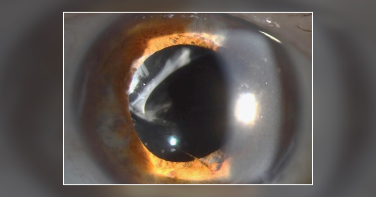A Case of Dislocated Intraocular Lens