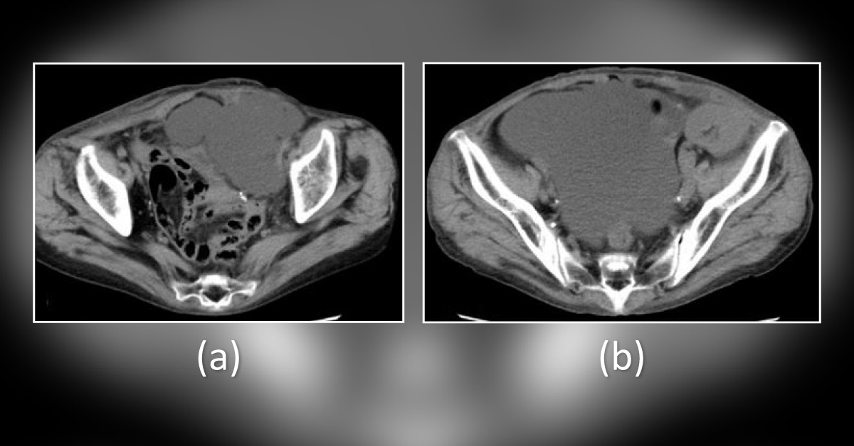 Case of Renal Transplantation Complications