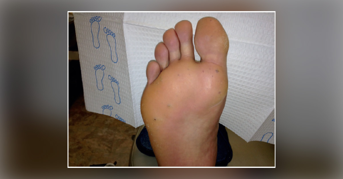 Identify the Reason Behind These Bleeding Lesions