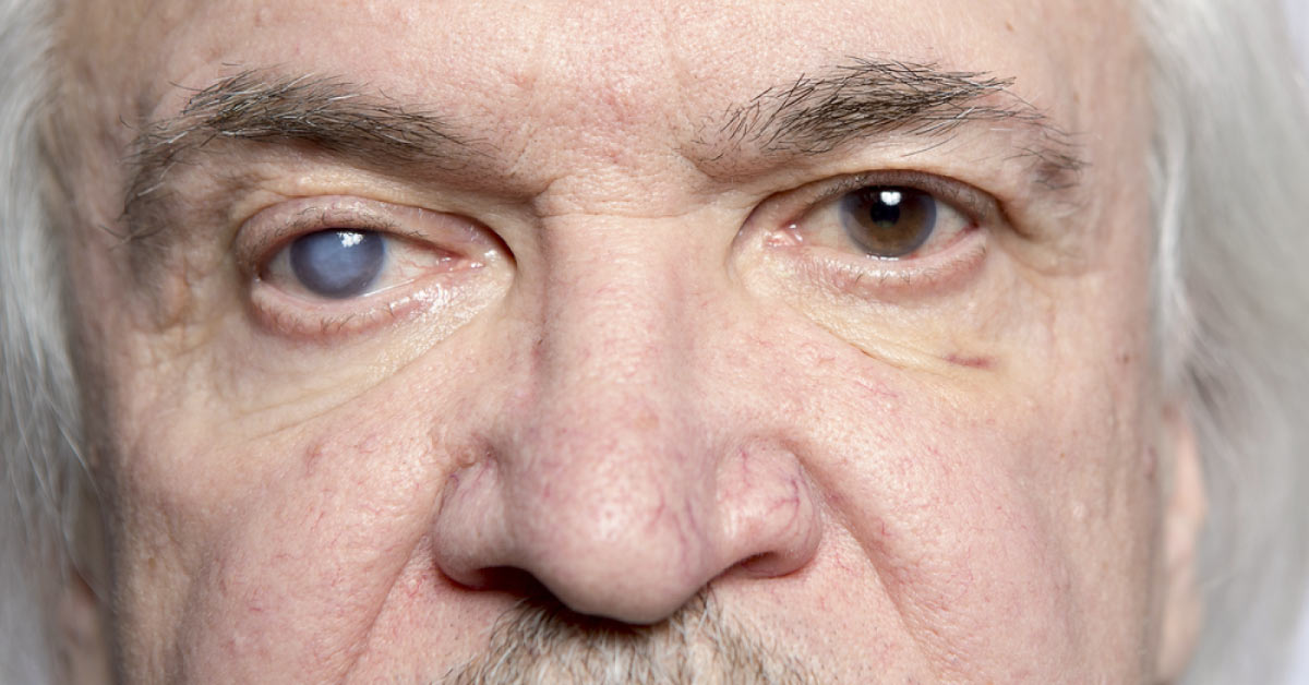 Brief Review On The Latest Information About Glaucoma