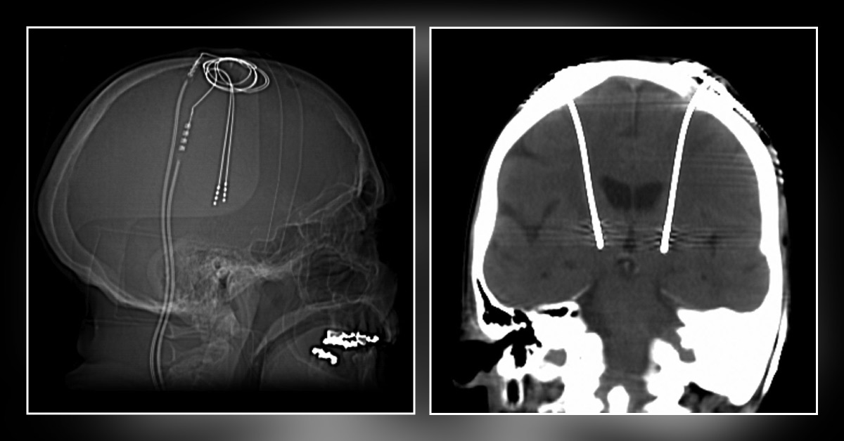 Name This Neurosurgery Procedure