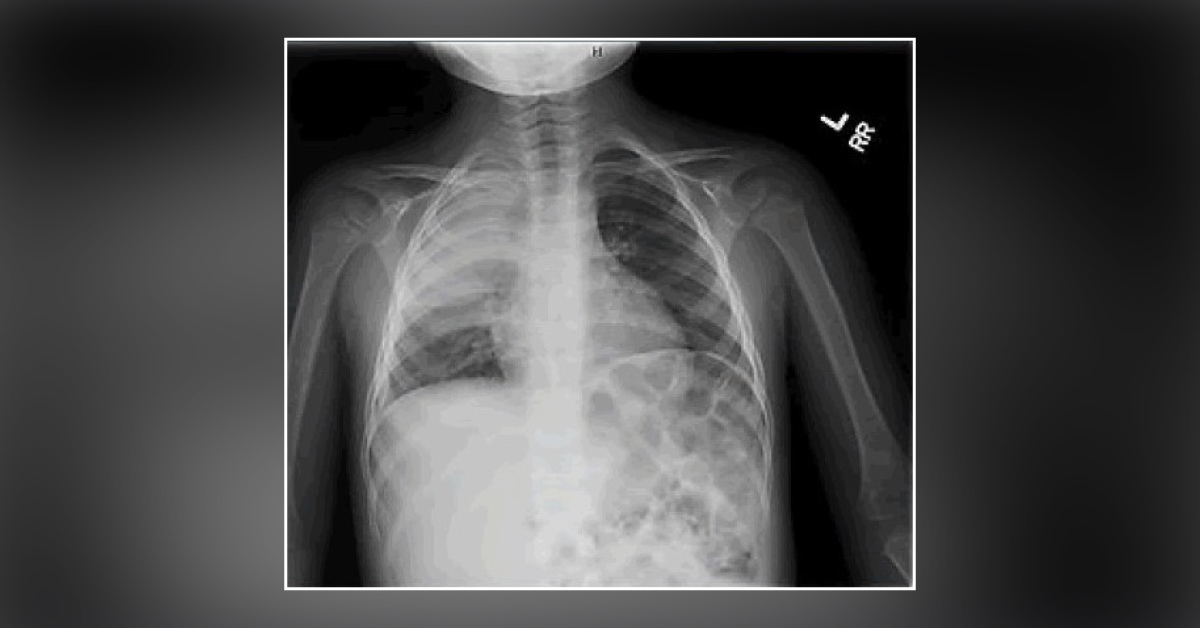 Does Viral Infection Have Any Association with Post Infectious Glomerulonephritis?