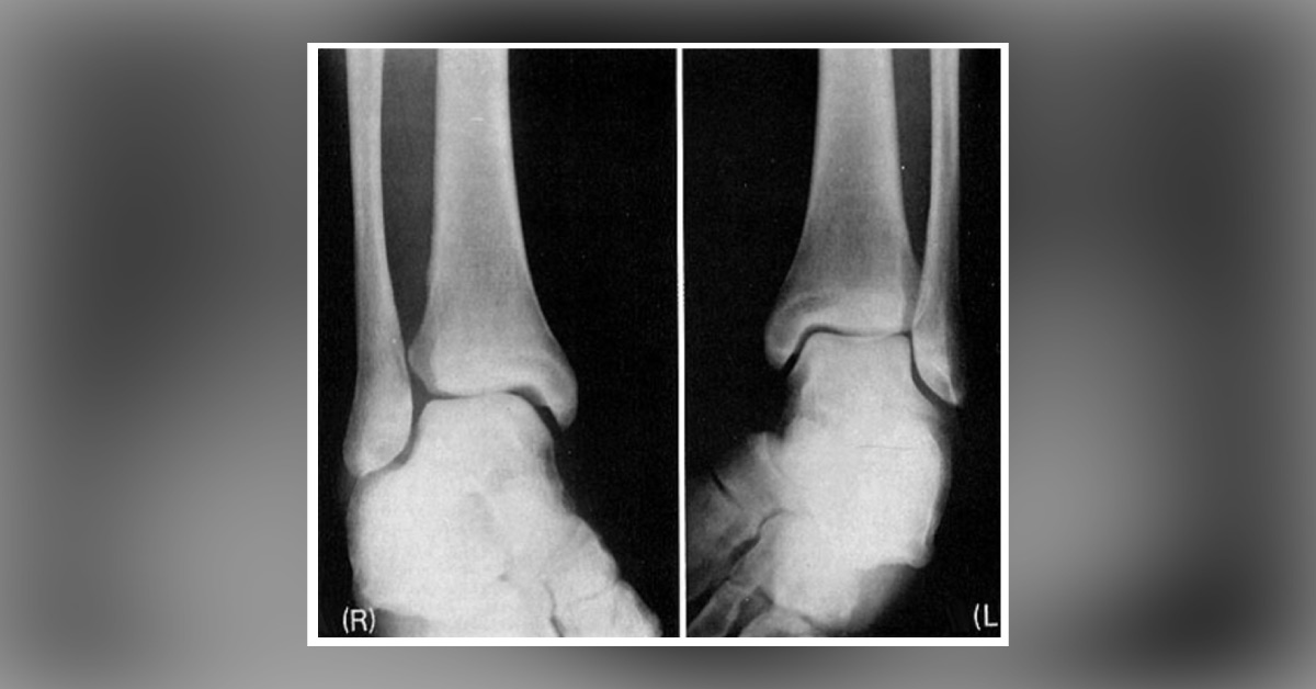 Case of a 24-year-old Athlete with Ankle Pain