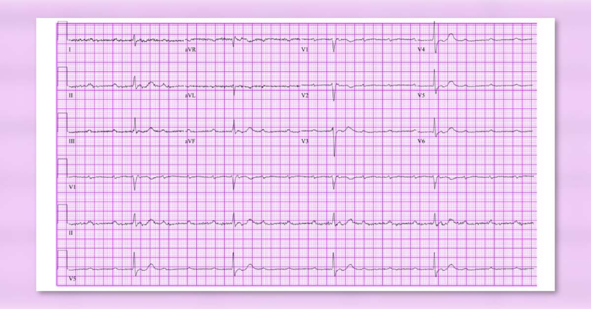 Diagnose This Case of Chest Pain