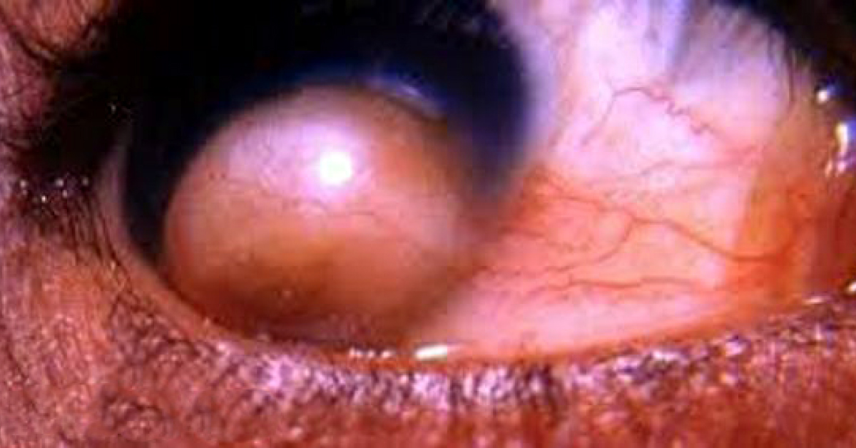 Brief Review On Goldenhar Syndrome