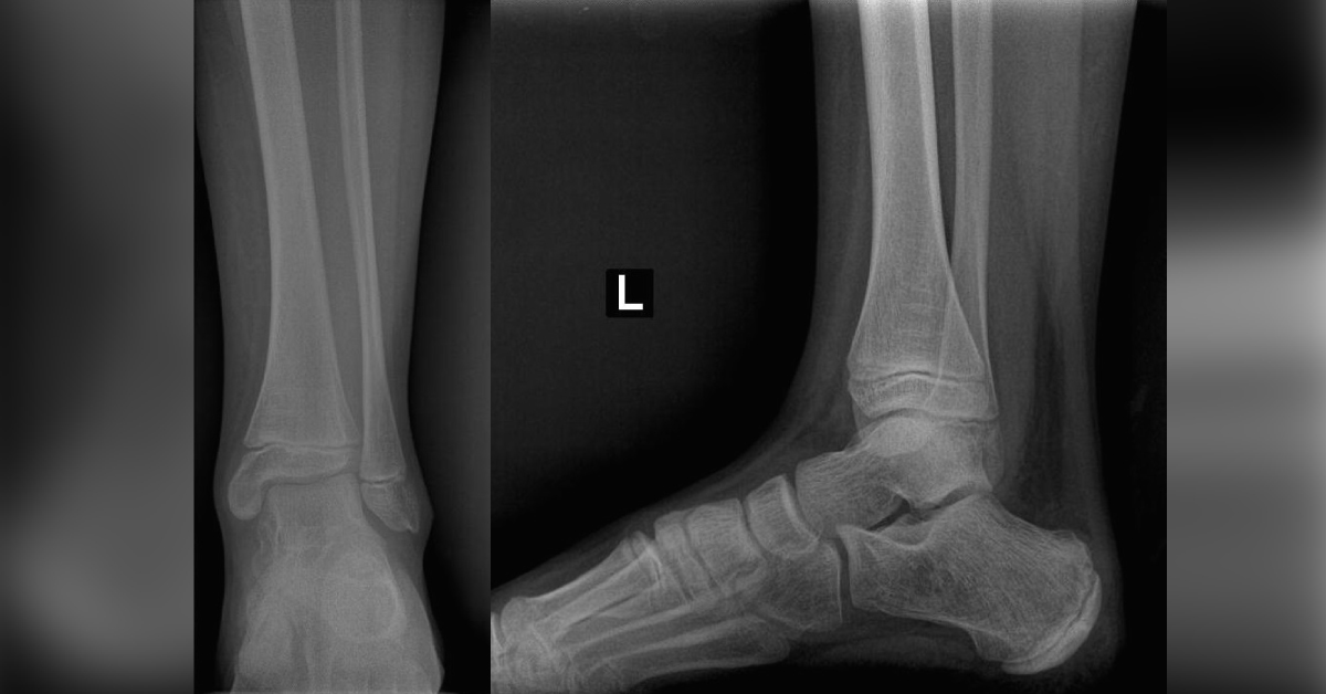 Diagnose This Boy Suffering With Ankle Pain