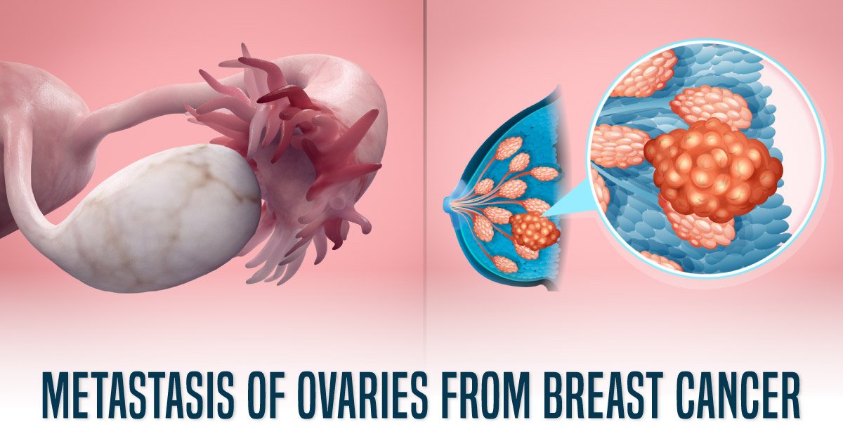 Women With Metastasis Of Ovaries From Breast Cancer