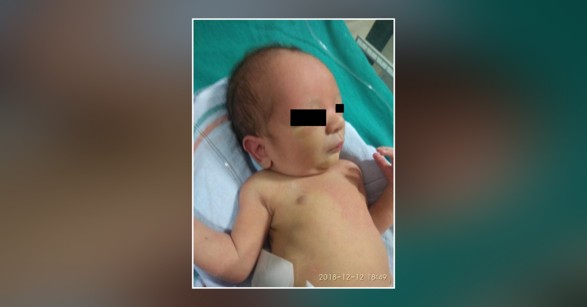 Increased Redness Over Upper Half Of The Body Of Newly Born