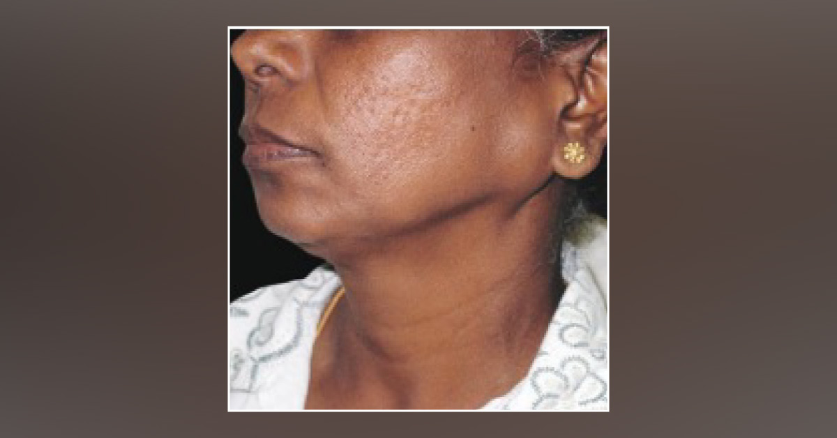 Case of a Woman with a Gradual Painless Swelling Around Her Left Ear