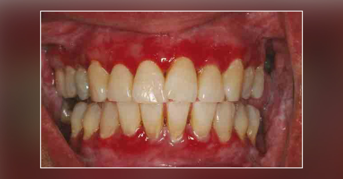 Recurrent Gingival and Oral Mucosal Lesions