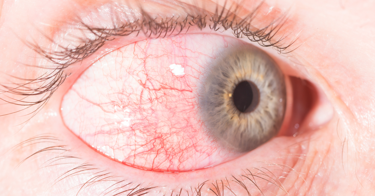 Brief Review On Ocular Manifestations Of Rheumatoid Arthritis