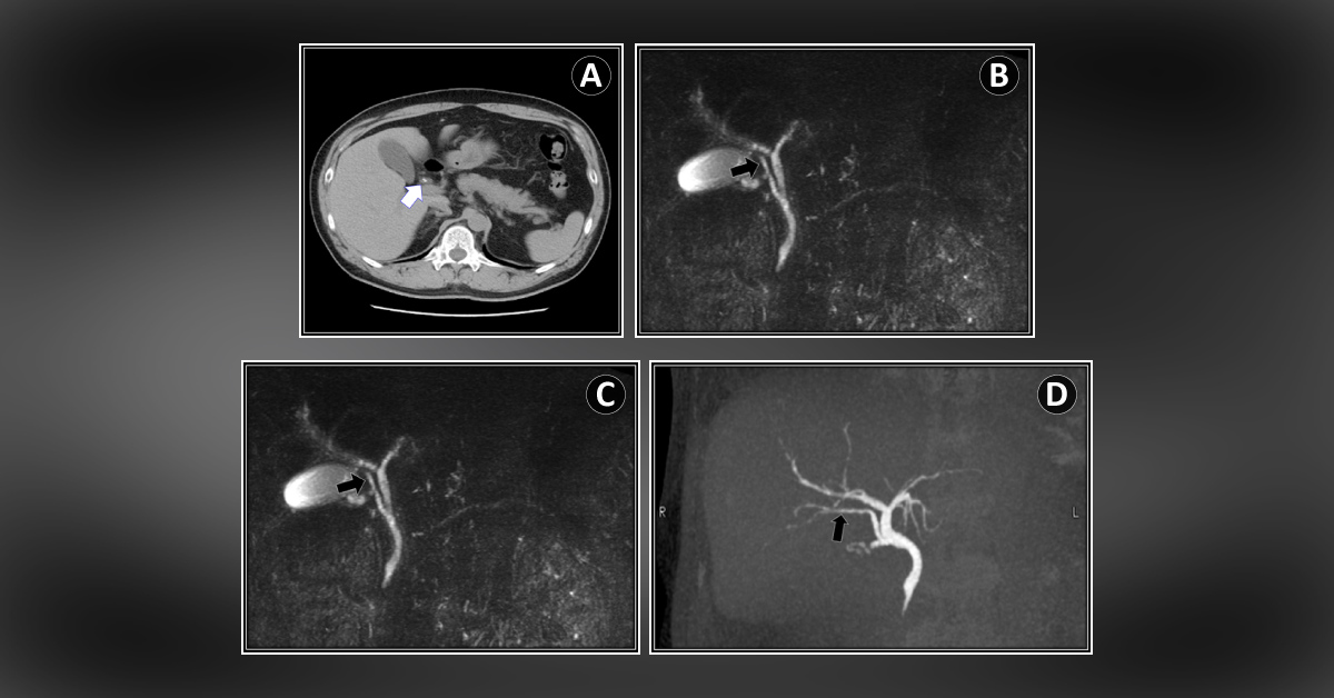 A Case of Laparoscopic Cholecystectomy