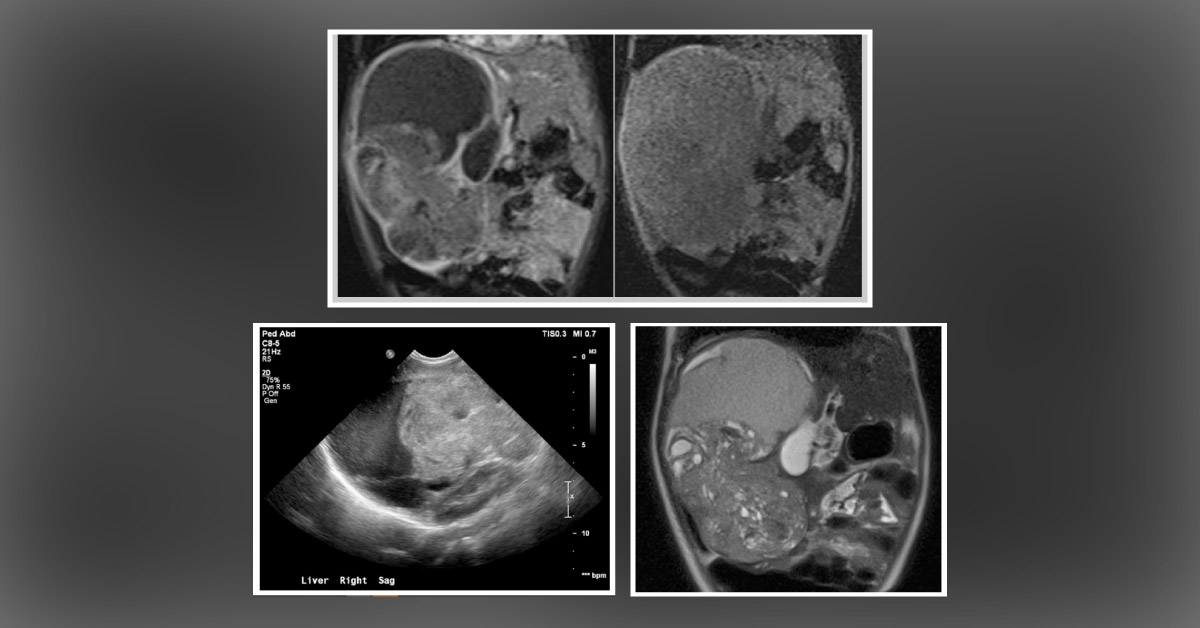 Case of an Infant Suspected to Have Leukemia