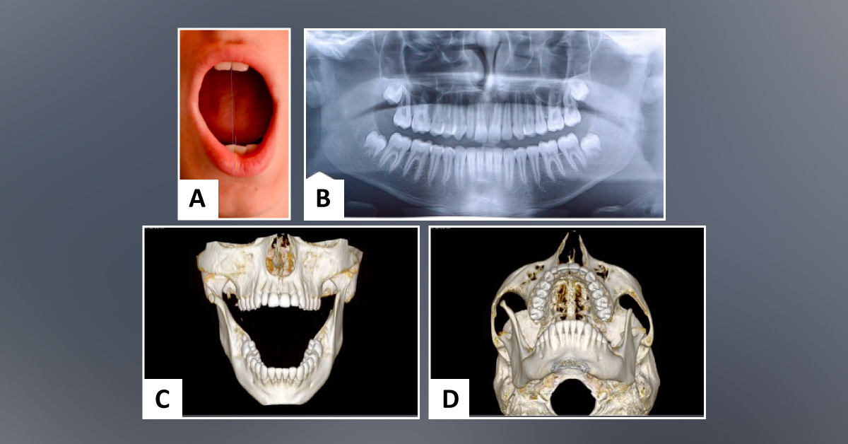 Case of a Boy with Facial Deformity